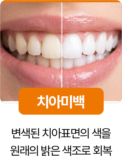 디디치과 치아미백 변색 치아 밝은 색조 회복