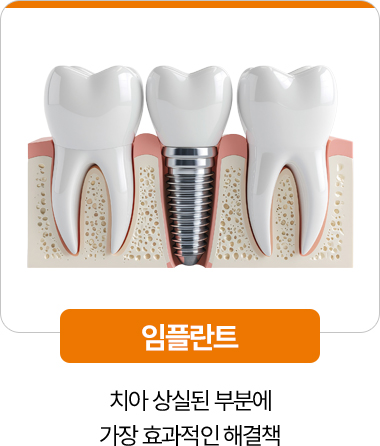 디디치과 임플란트 치아 상실 부위 해결