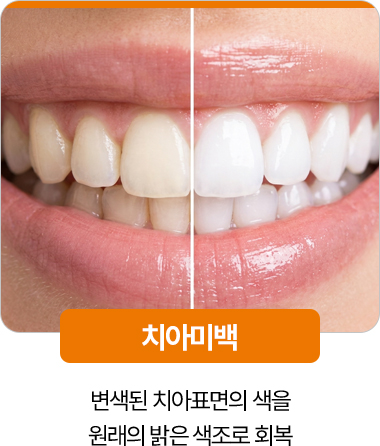 디디치과 치아미백 변색 치아 밝은 색조 회복